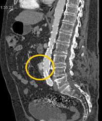 Endoleak - CTisus CT Scan