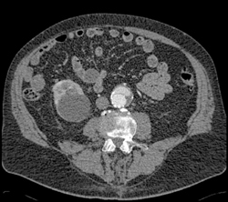 Endoleak - CTisus CT Scan