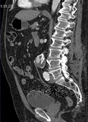 Endoleak - CTisus CT Scan