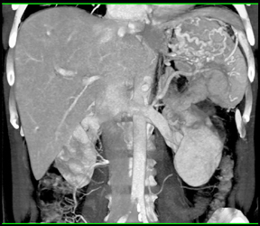 Splenic Vein Occlusion With Varices - CTisus CT Scan