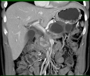 Pancreatic Pseudocysts Compress the Splenic Vein and Give Gastric Varices - CTisus CT Scan