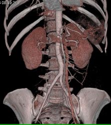 Normal Mesenteric Arcade - CTisus CT Scan