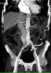 Aorta-IVC Fistulae - CTisus CT Scan