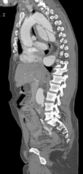 Aortic Dissection - CTisus CT Scan