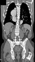 Aortic Dissection - CTisus CT Scan