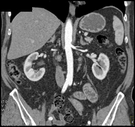 Prehilar Branching of the Renal Artery - CTisus CT Scan