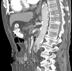 Clot in the SMA - CTisus CT Scan