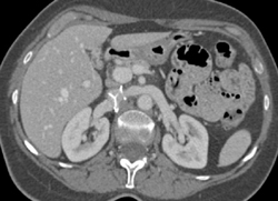 Misplaced IVC Filter - CTisus CT Scan