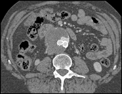 Endoleak - CTisus CT Scan