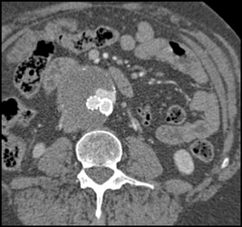 Endoleak - CTisus CT Scan