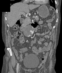 Endoleak - CTisus CT Scan