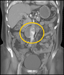 Endoleak - CTisus CT Scan