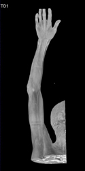 CTA of the Upper Extremity With Extensive Calcification - CTisus CT Scan