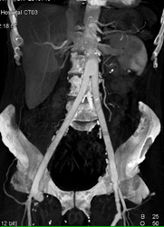 Femoral Aorto-stents - CTisus CT Scan