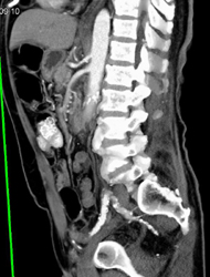 Plaque in SMA and Celiac Artery - CTisus CT Scan