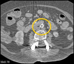 Clot in Aorta - CTisus CT Scan