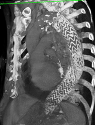 Stent in Arch - CTisus CT Scan