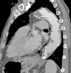 Ulcers in Aorta - CTisus CT Scan