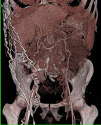 Collaterals Abdominal Wall With SVC Occlusion. Collaterals Drain Into the Right Iliac Veins - CTisus CT Scan