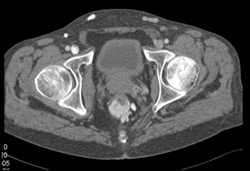 Perirectal Collaterals - CTisus CT Scan