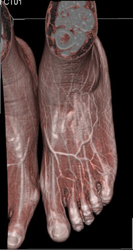 3D Rendering of the Vascular Map of the Foot - CTisus CT Scan