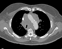 NSCLC Encases the Pulmonary Artery - CTisus CT Scan