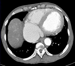 Huge Atrium With IVC Reflux - CTisus CT Scan