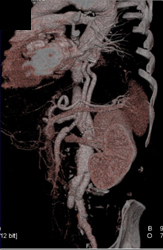 Abdominal Aortic Aneurysm Repair - CTisus CT Scan