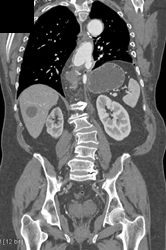 Bypass Grafts Off Aorta to Mesenteric Arteries - CTisus CT Scan