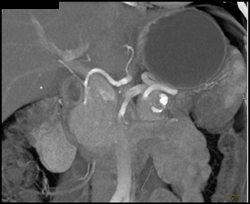 Splenic Artery Aneurysm - CTisus CT Scan