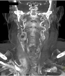 Tortuous Carotid Arteries in Loeys-Dietz Syndrome - CTisus CT Scan