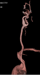 Edited Tool for Segmentation of the Carotid Artery - CTisus CT Scan