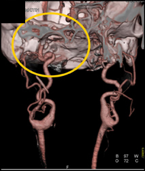 VRT vs MIP Without Need for Editing - CTisus CT Scan