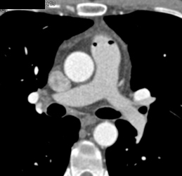 Air in Pulmonary Artery Due to Poor Technique - CTisus CT Scan