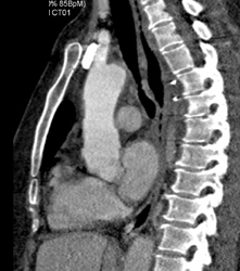 Motion in Ascending Aorta as Stair-stepping When in Wrong Reconstruction Phase - CTisus CT Scan