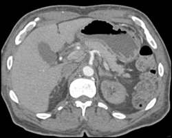 Superior Mesenteric Artery (SMA) Stenosis Best Seen on Sagittal Projection - CTisus CT Scan