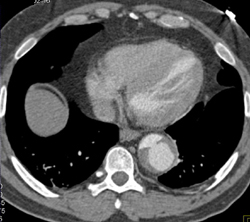 Ulcer in Descending Aorta - CTisus CT Scan