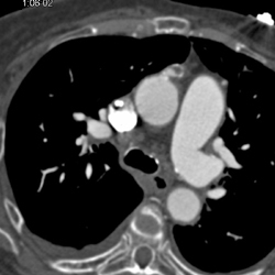 Focal Pseudoaneurysm Off Arch - CTisus CT Scan