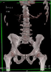 Abdominal Aortic Aneurysm (AAA) With Automated Editing Tool - CTisus CT Scan