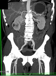 Abdominal Aortic Aneurysm (AAA) With Automated Editing Tool- VRT and MIP - CTisus CT Scan