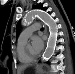 Endovascular Stent - CTisus CT Scan