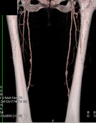 Peripheral Vascular Disease (PVD) in SFA - CTisus CT Scan