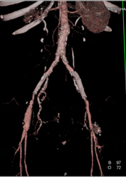 Stent in Right External Iliac Artery - CTisus CT Scan