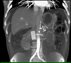 Stent in IVC and Left Renal Vein - CTisus CT Scan