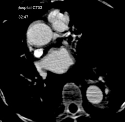 Incidental Clot in Left Anterior Descending Coronary Artery - CTisus CT Scan