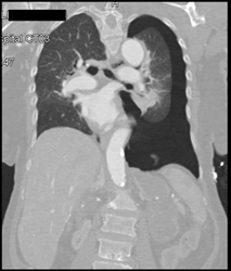 Pneumothorax - CTisus CT Scan