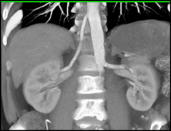 Ectopic Right Renal Artery Into the Thoracic Aorta - CTisus CT Scan