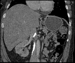 Calcified IVC Clot - CTisus CT Scan