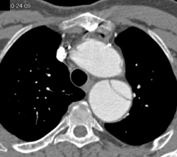 Descending Aortic Dissection Extends Into SMA - CTisus CT Scan