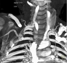 Ectatic Carotid Artery 20 to Loeys-Dietz?? - CTisus CT Scan